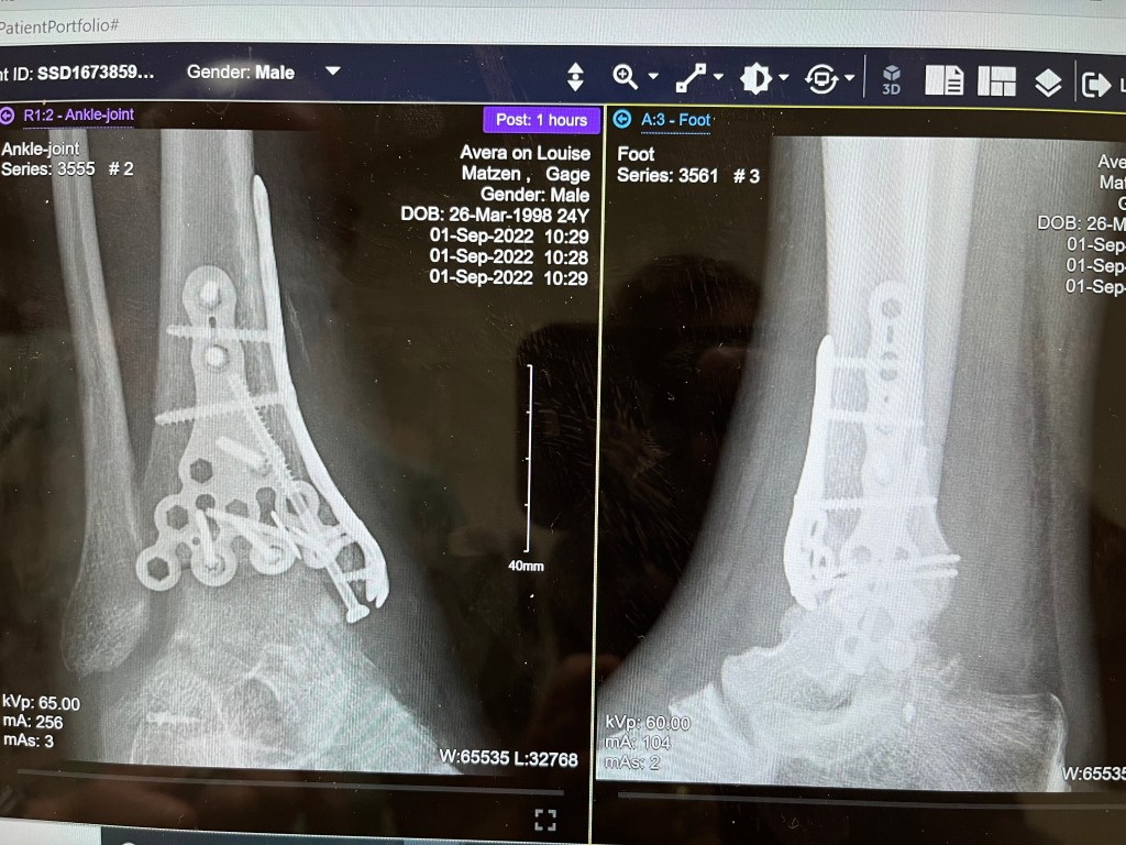 X-ray images showing a fused right ankle joint with surgical hardware.